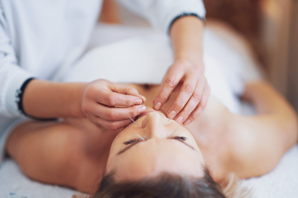 imagen de acupuntura estética en cara