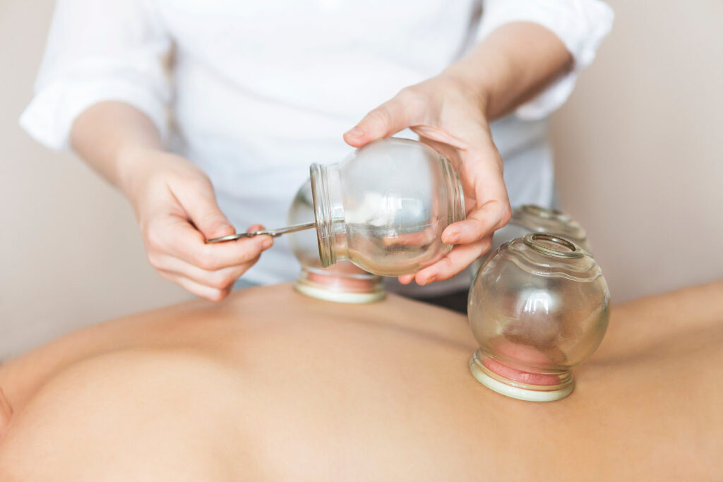 imagen de sesión de acupuntura cupping