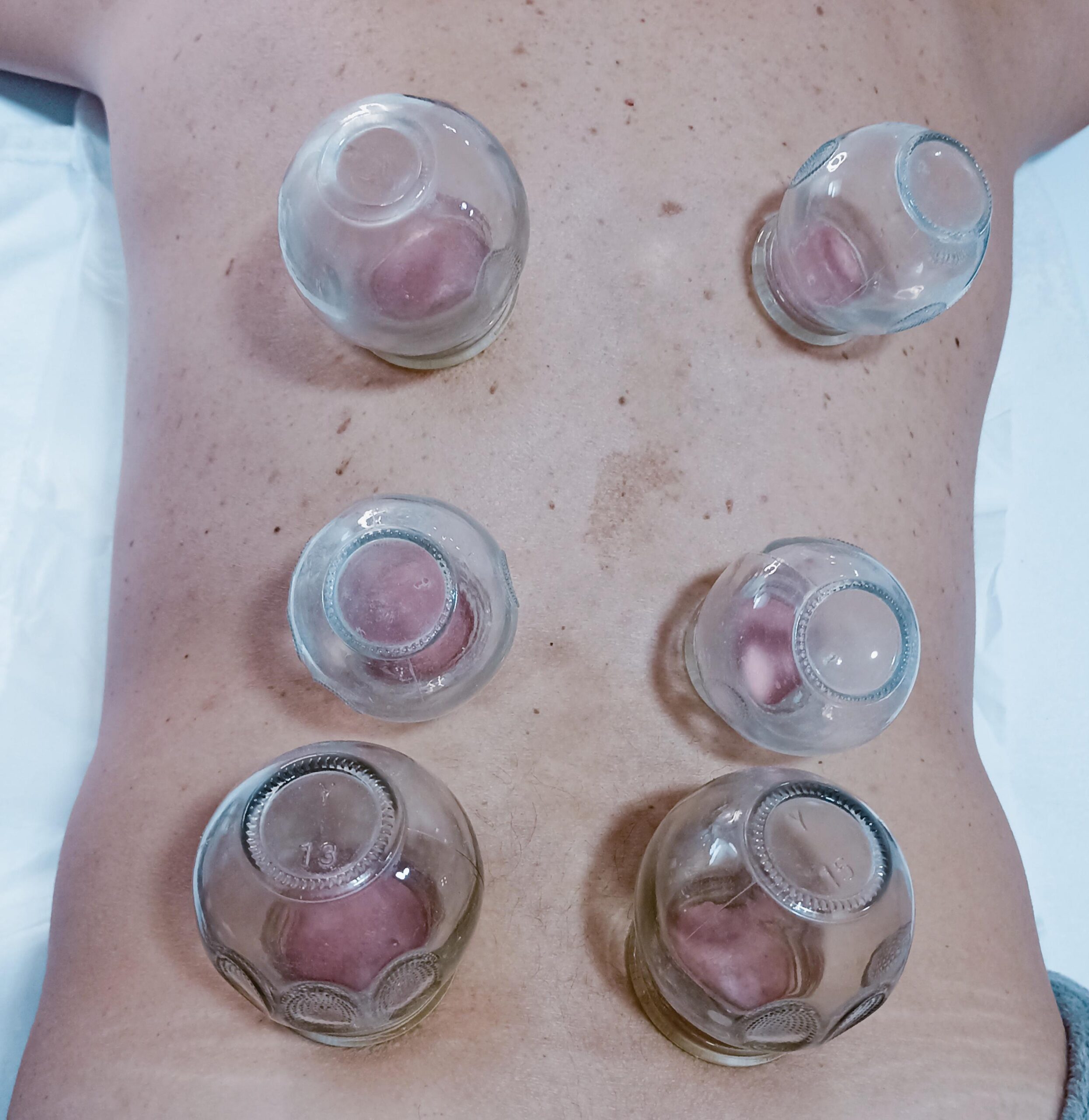 imagen ventosas cupping en espalda