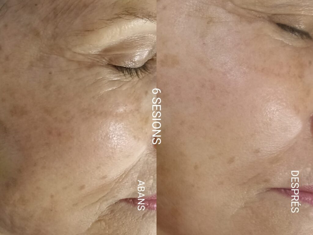 imagen comparativa de mejora en rostro después de acupuntura facial