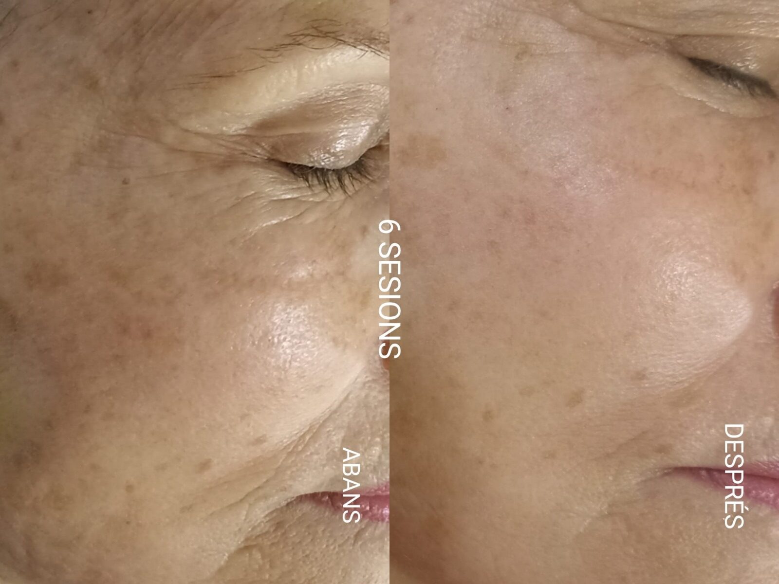 imagen comparativa de mejora en rostro después de acupuntura facial