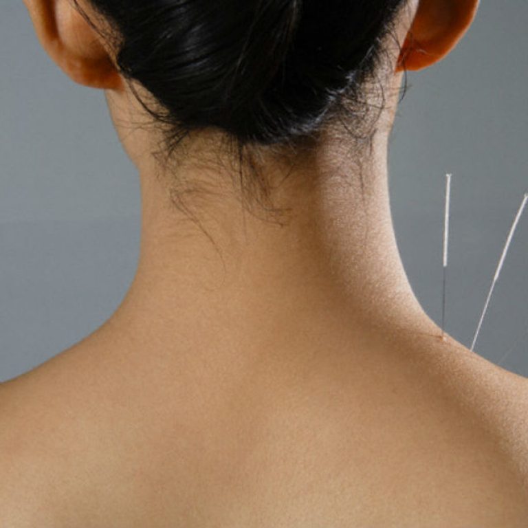 imagen espalda persona con acupuntura en cuello