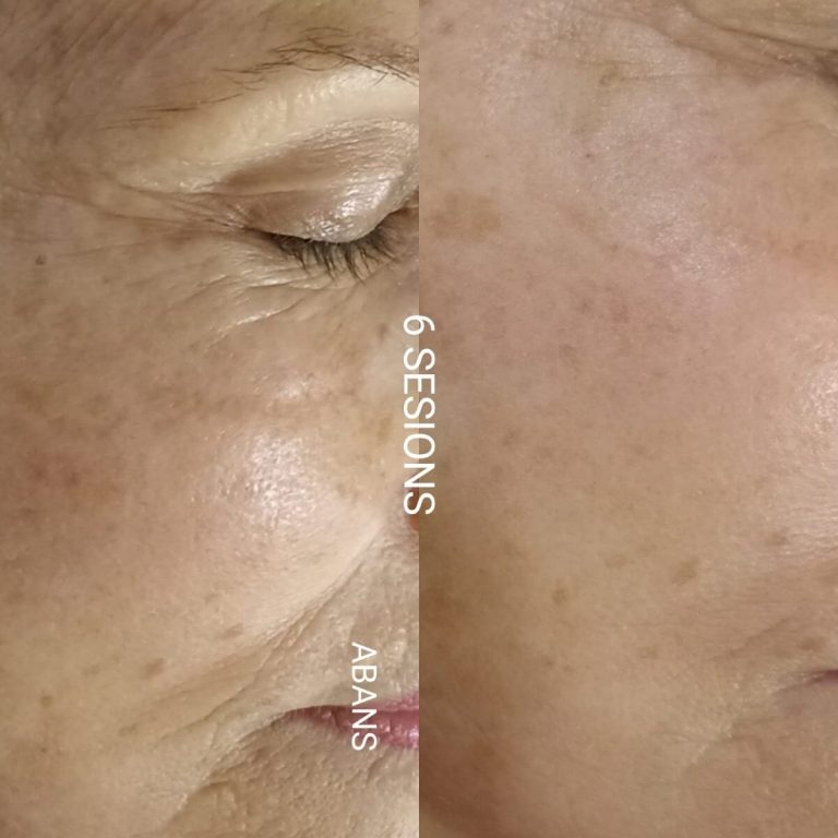 imagen comparativa de mejora en rostro después de acupuntura facial